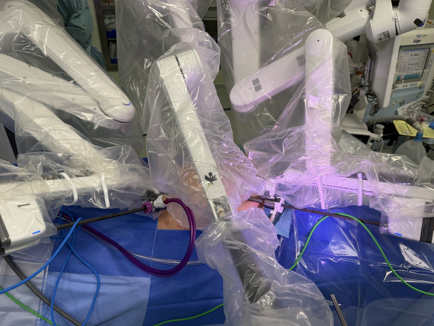 Da Vinci robotic surgical arms operating through tiny incisions